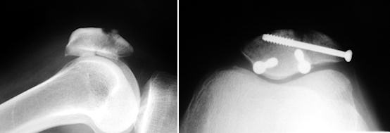 Patella kırığı tedavisi röntgen