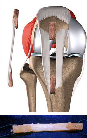 Patellar tendon alınması