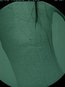 Diz çıkığı sonrası popliteal arter trombozuna ait anjiyografi görüntüsü