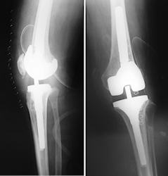 Aynı hastanın posterior stabilize implantlar ile revizyonu