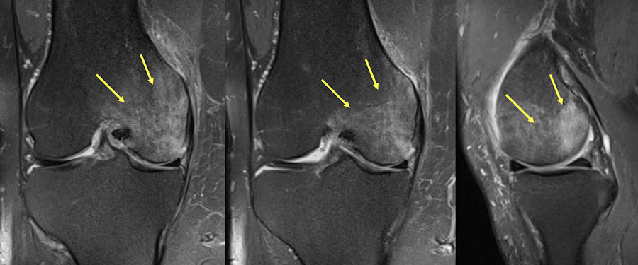 Resim 7: Femur kemiği iç tarafında oklar ile işaretli yaygın kemik iliği ödemi alanı (Normal kemik iliği gri renklidir, ödem alanı beyaz olarak görülür). Resim 7: Femur kemiği iç tarafında oklar ile işaretli yaygın kemik iliği ödemi alanı (Normal kemik iliği gri renklidir, ödem alanı beyaz olarak görülür).