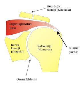 Resim 1: Kısmi rotator manşet yırtığı