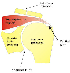 Figure 1: Partial rotator cuff tear.