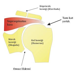 Resim 2: Tam kat rotator manşet yırtığı