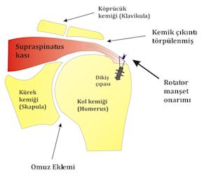 Resim 5: Rotator manşet onarımı