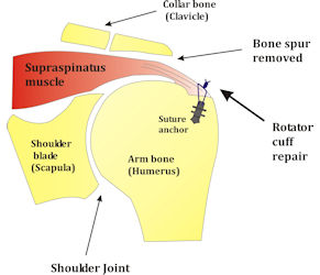 Figure 5: Rotator cuff repair 