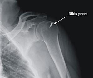 Figure 6: X-ray image of a patient who underwent rotator cuff repair using a titanium suture anchor.