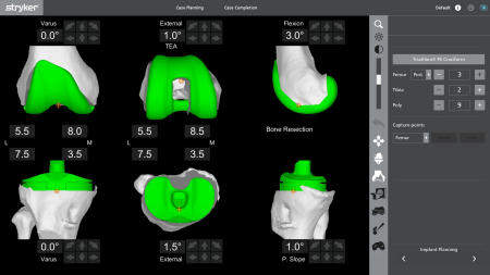Picture 1a: Sizing and orientation of implants in the pre-operative plan.