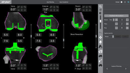 Picture 1b : Planning of the bone cuts.