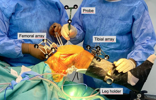 Picture 2: Placement of arrays and bone registration during surgery