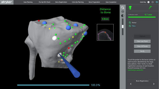 Picture 3 : Bone registration defines your knee to the robotic system