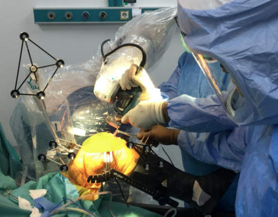 Picture 4 : Bone cuts being performed with the aid of the robotic system Picture 4 : Bone cuts being performed with the aid of the robotic system
