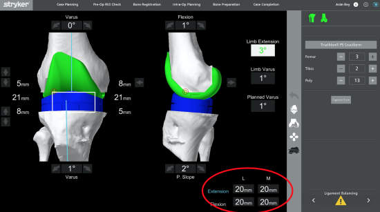 Picture 5: Evaluating soft tissue balance with the aid of the robotic system with trial components in place.