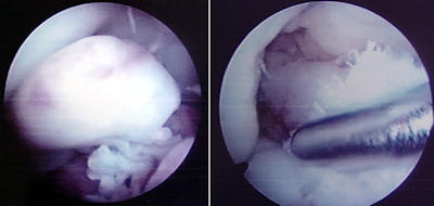 Siklops sendromu ve artroskopik eksizyon sonrası görünümü
