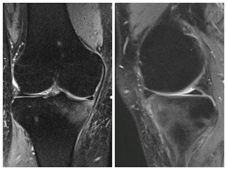 Resim 1: MRG’de tibia kemiğinde kemik iliği ödemi, siyah olması gereken kemikteki beyaz alanlar ödemi gösteriyor.