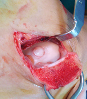 Malleol osteotomisi sonrası talusa uygulanan mozaikplasti Malleol osteotomisi sonrası talusa uygulanan mozaikplasti