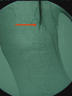 Çoklu bağ yaralanması sonrası popliteal arter tam oklüzyonunu gösteren anjiyogram Çoklu bağ yaralanması sonrası popliteal arter tam oklüzyonunu gösteren anjiyogram