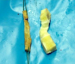Otojen ve allogreft patellar tendon grefti Otojen ve allogreft patellar tendon grefti