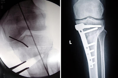 Tomofix ile açık kama osteotomisi. İntra-op ve kaynama sağlandıktan sonraki görünüm Tomofix ile açık kama osteotomisi. İntra-op ve kaynama sağlandıktan sonraki görünüm