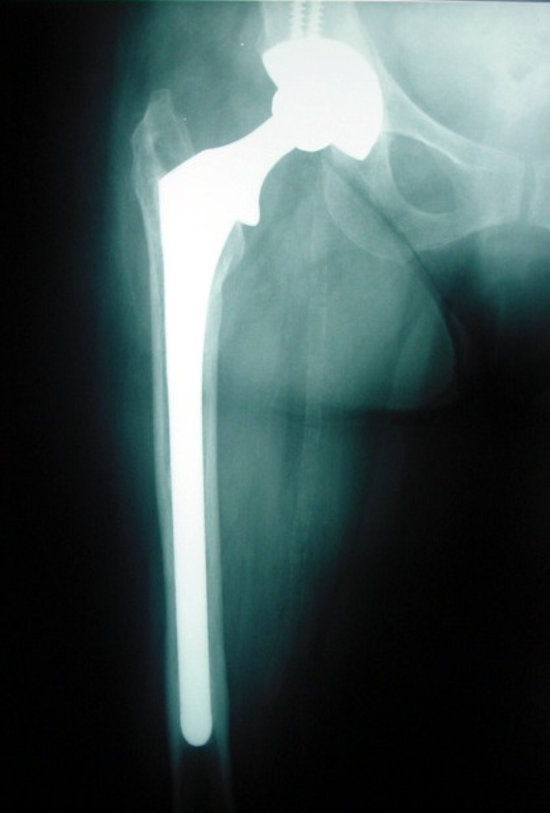 Kalça protezi uygulanmış bir hastanın röntgen görüntüsü