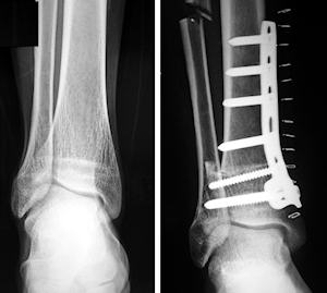 Valgus ayak bileğinde düzeltici osteotomi